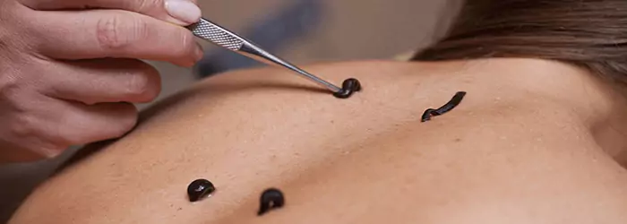 Raktamokshana Treatment at Ayur Harsha in Kothapet,Hyderabad