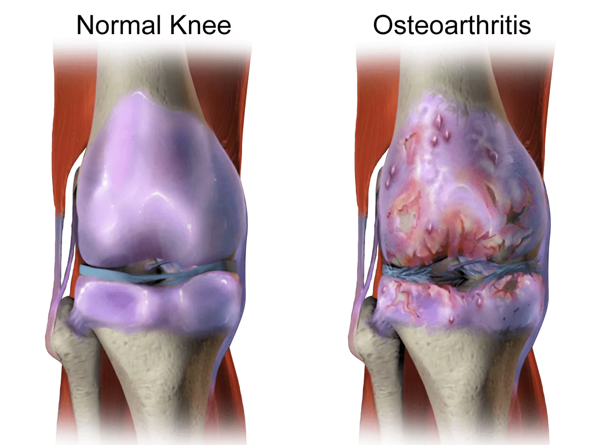 Ayurvedic Treatment for Osteoarthritis at AyurHarsha in Kothapet
