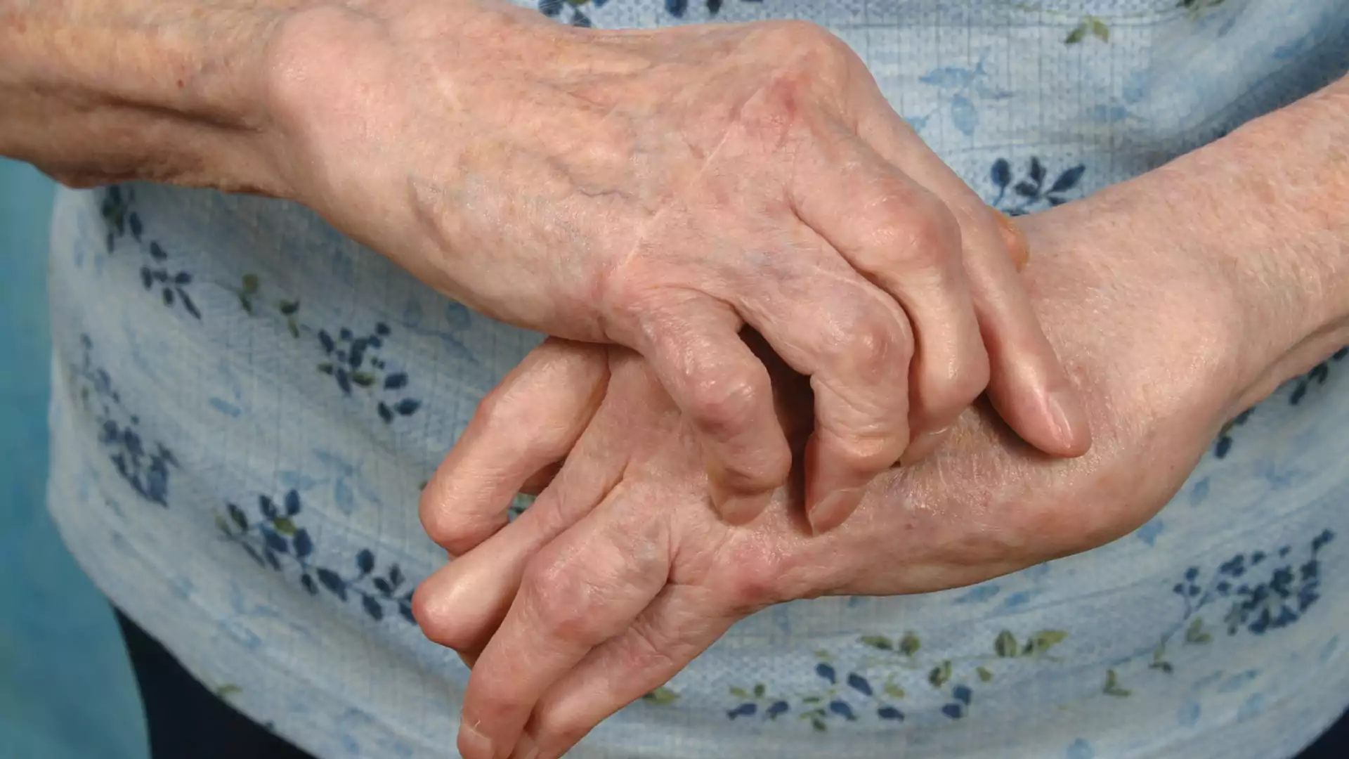 Ayurvedic Treatment for Rheumatoid Arthritis – Ayur Harsha, Kothapet, Hyderabad