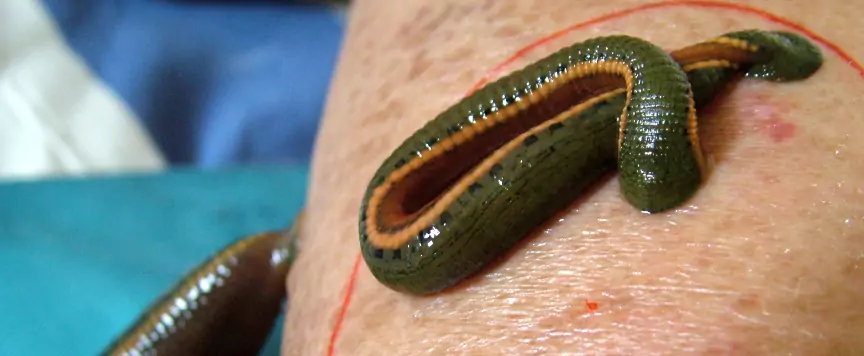 Leech Therapy in Ayurveda: Ancient Healing at Ayur Harsha in Kothapet, Hyderabad