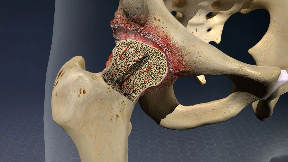 Avascular Necrosis Treatment in Ayurveda  at  Ayur Harsha in Kothapet,Hyderabad